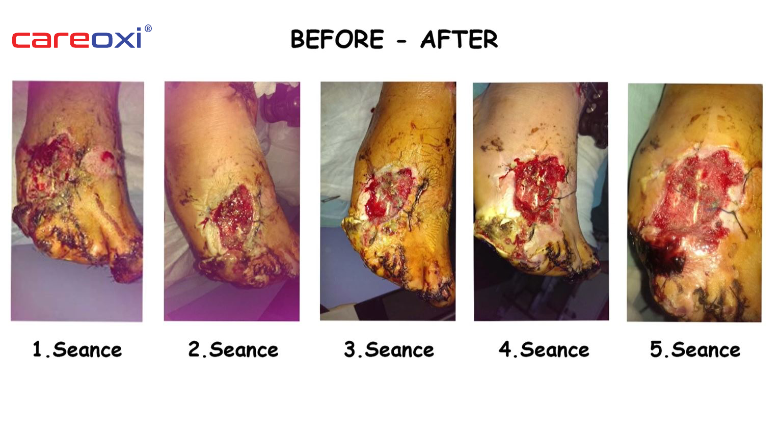 NPWT Wound Treatment Traumatic Case Results